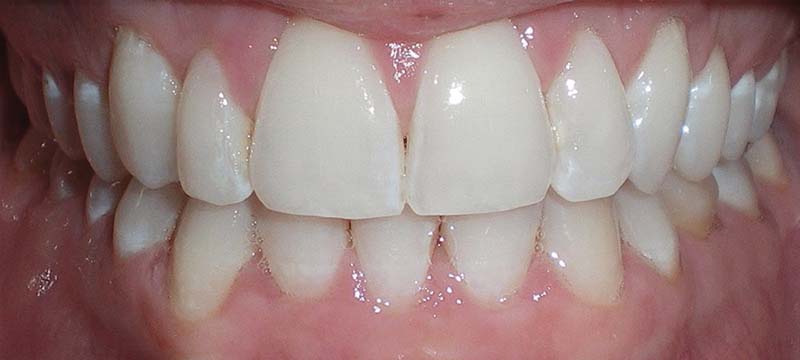 Teeth whitening after treatment