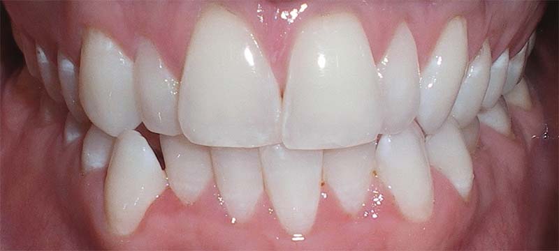 Teeth whitening before treatment