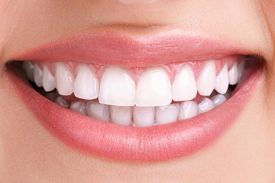 Teeth whitening after treatment