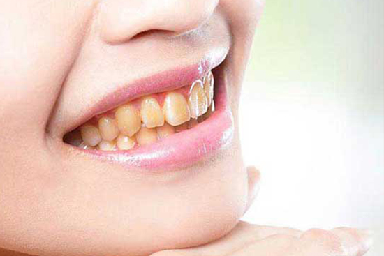 Porcelain veneers before treatment