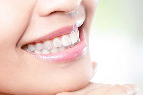 Porcelain veneers after treatment