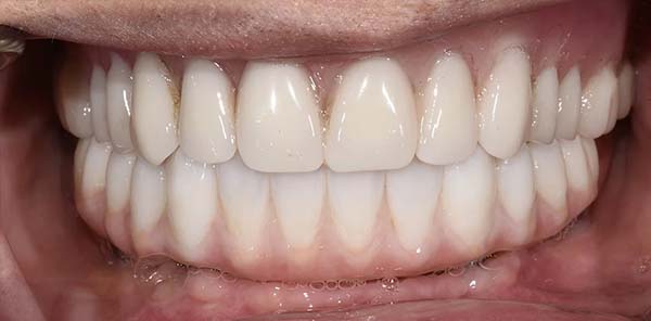Teeth whitening after treatment