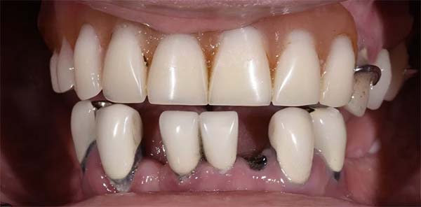Teeth whitening before treatment