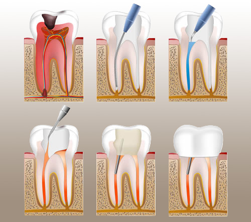 Root canal treatment procedure