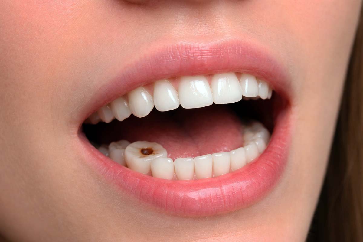 What Causes Cavities and How to Prevent Them